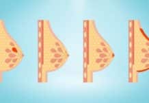 Les différents types de cancer du sein
