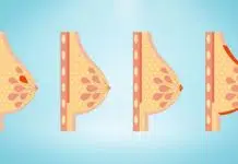 Les différents types de cancer du sein