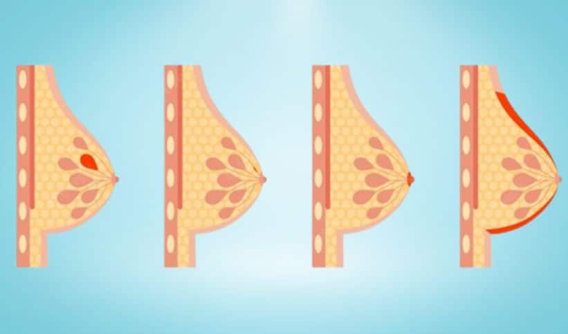 Les différents types de cancer du sein