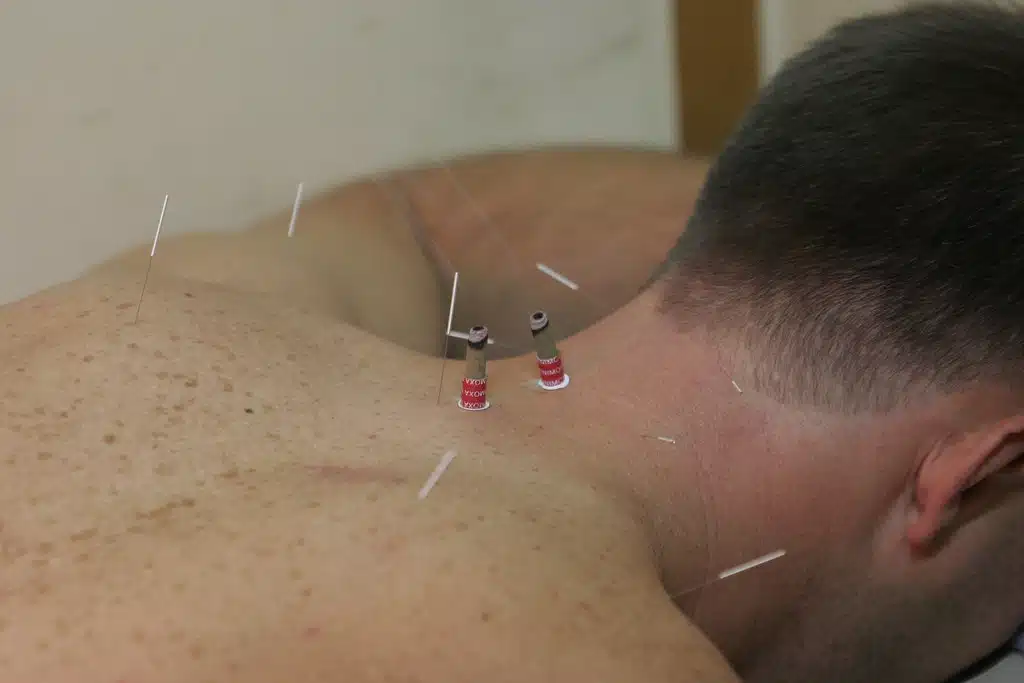 Les bienfaits de l’acupuncture pour la santé