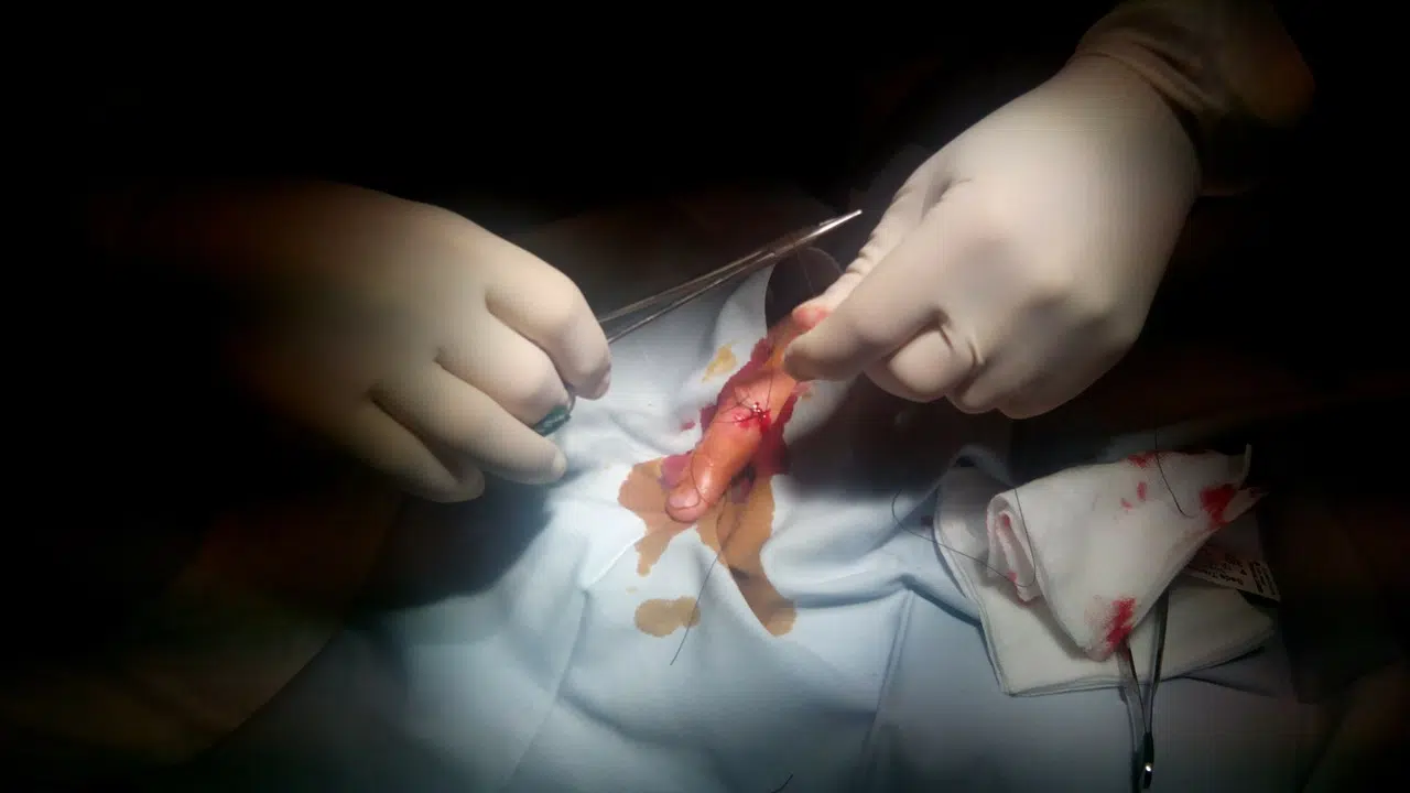 chirurgie du doigt à ressaut